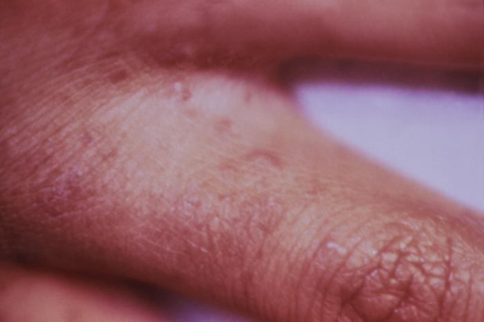 Lesiones compatibles con sarna entre los dedos de una mano.